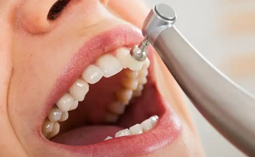 Dentista de la Seguridad Social: 5 tratamientos gratis que te ocultan 10 limpieza dental